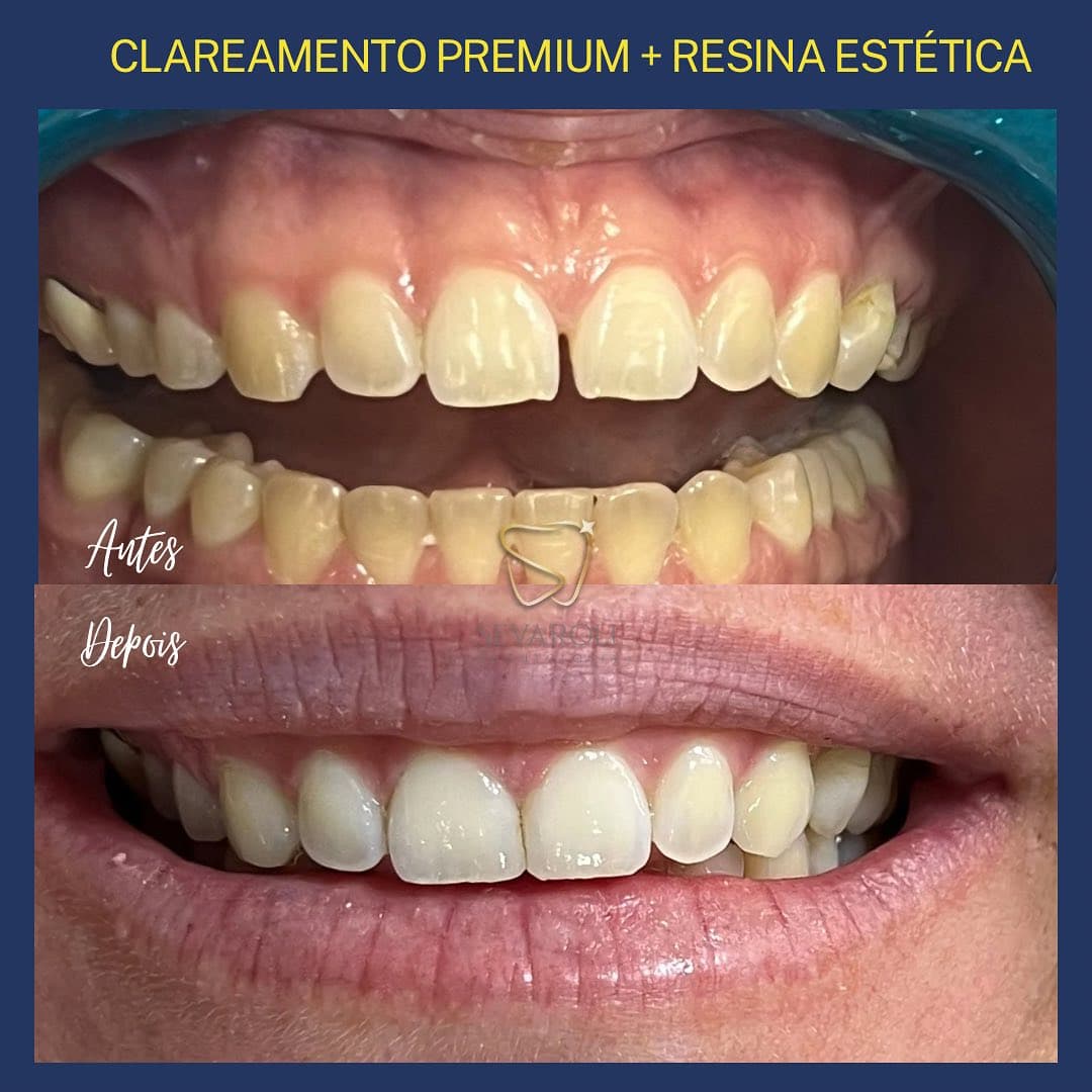 CLAREAMENTO PREMIUM + RESINA ESTÉTICA