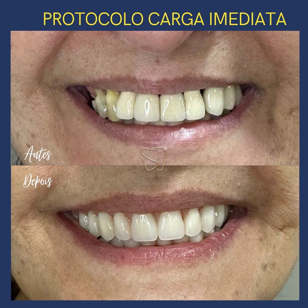 PROTOCOLO CARGA IMEDIATA