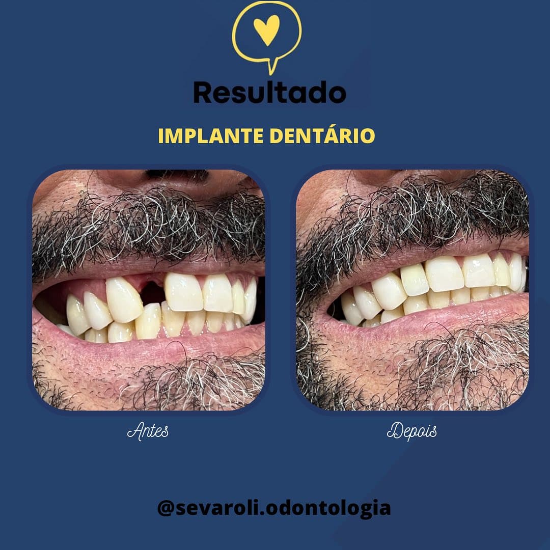 IMPLANTE DENTÁRIO