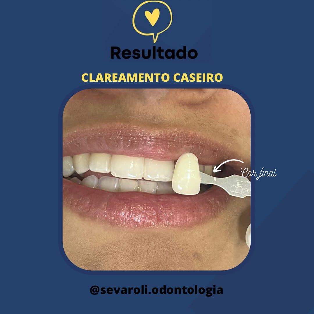 CLAREAMENTO CASEIRO