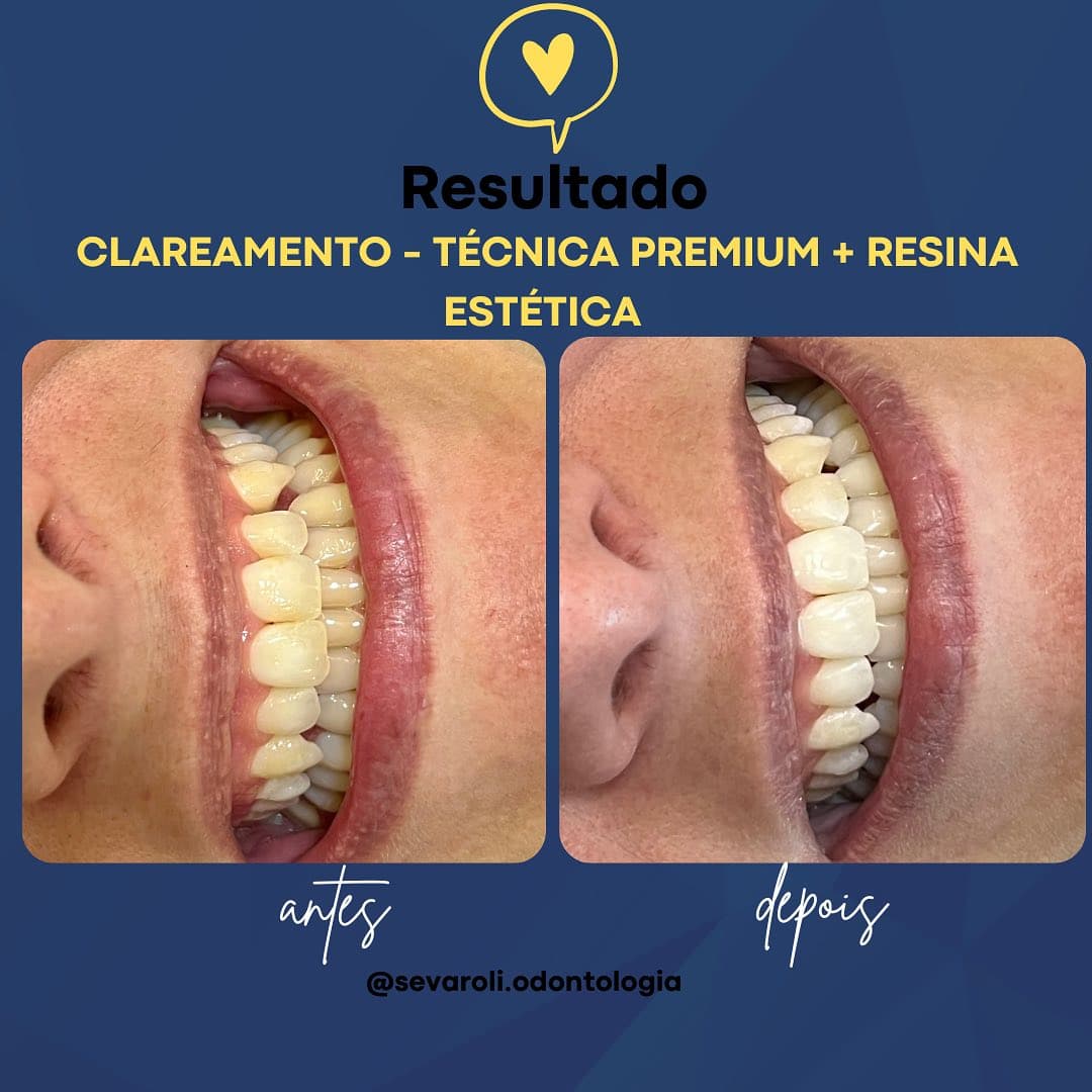 CLAREAMENTO - TÉCNICA PREMIUM + RESINA ESTÉTICA