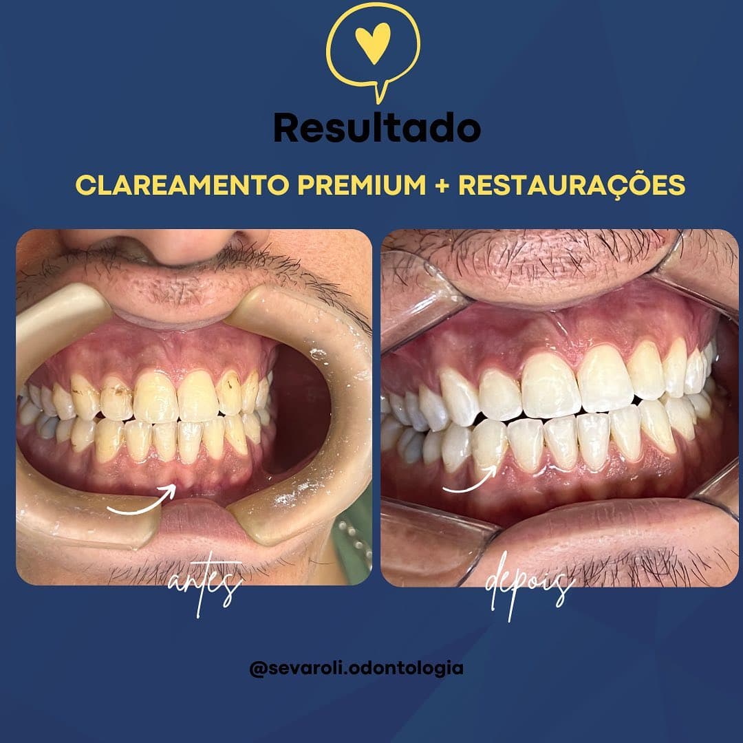CLAREAMENTO PREMIUM + RESTAURAÇÕES