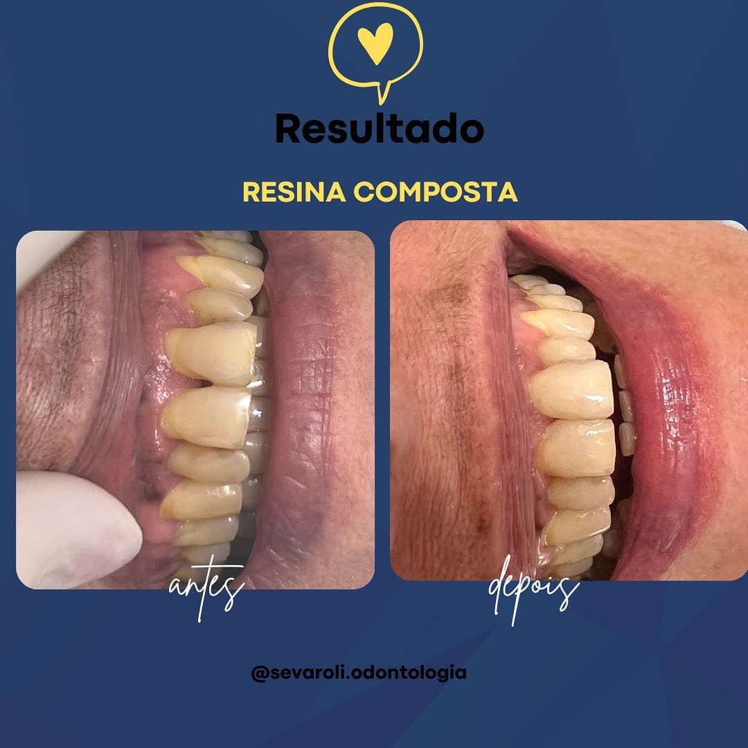 RESINA COMPOSTA